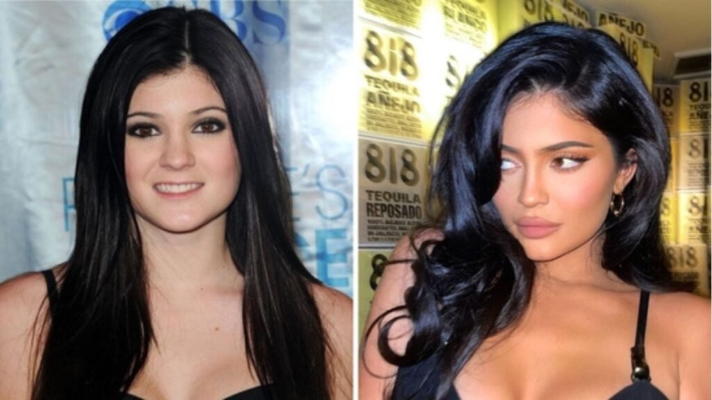Kylie Jenner Before and After Plastic Surgery