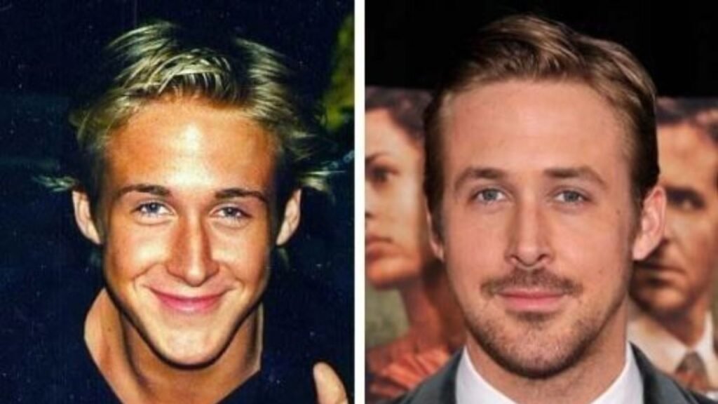Ryan Gosling Plastic Surgery