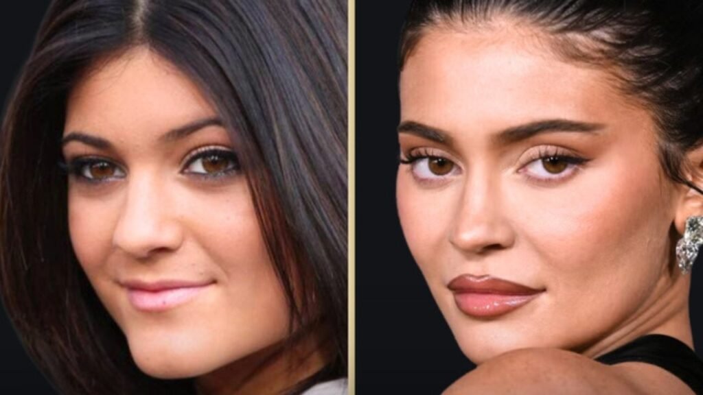 Kylie Jenner’s Lip Fillers