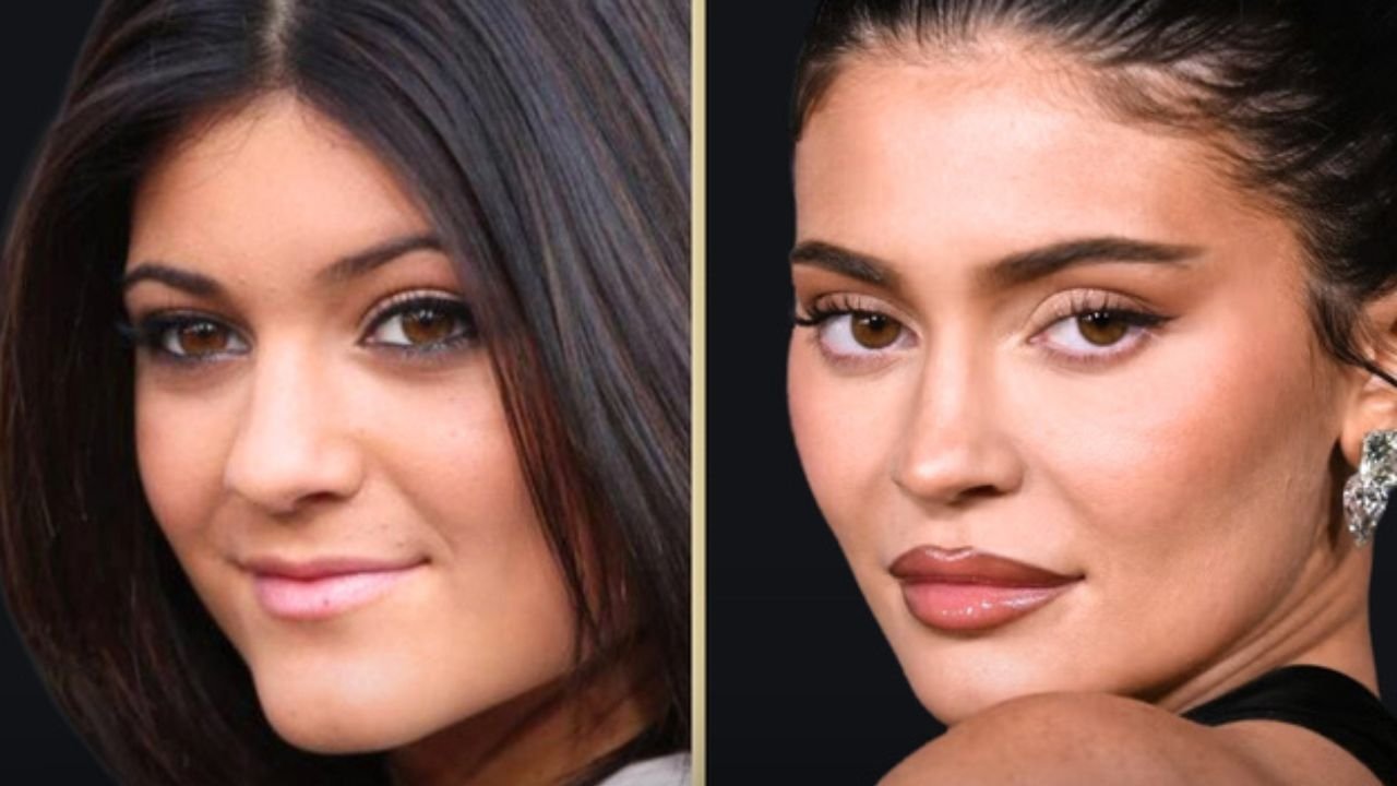 Kylie Jenner Before and After Plastic Surgery Photos